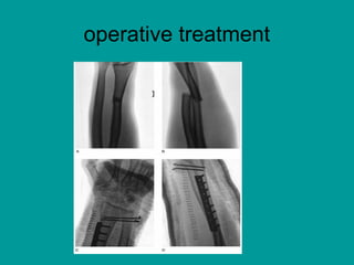 Fracture of Forearm Bones | PPT