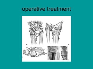 Fracture of Forearm Bones | PPT