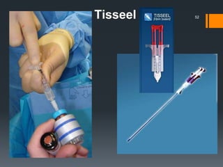 Tisseel 52
 