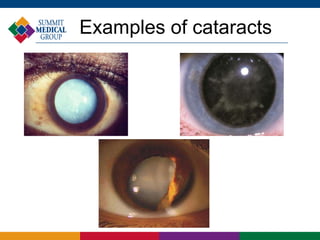 Demystifying Cataracts and Cataract Surgery | PPTX