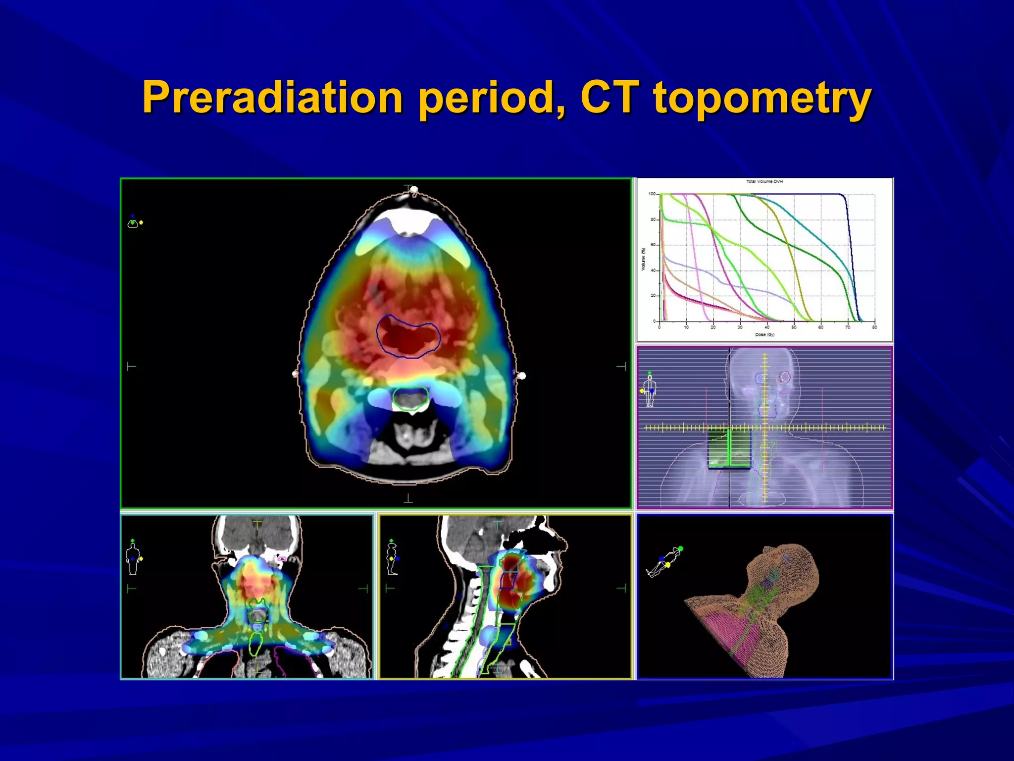 PreradiationPreradiation period, Сperiod, СT topometryT topometry
 
