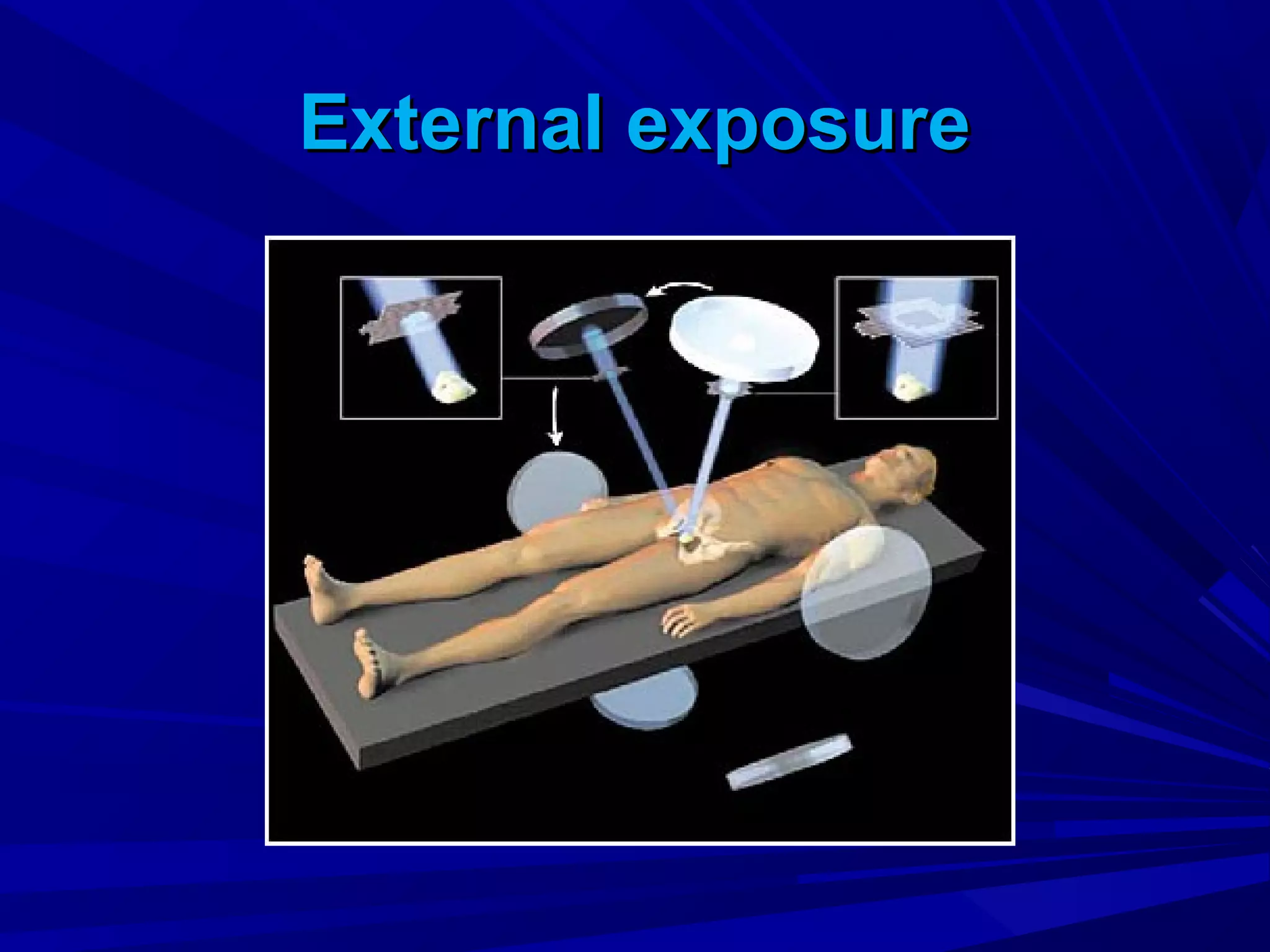 External exposureExternal exposure
 