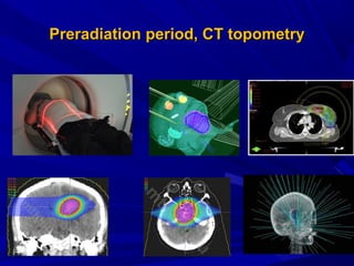 PreradiationPreradiation period, Сperiod, СT topometryT topometry
 
