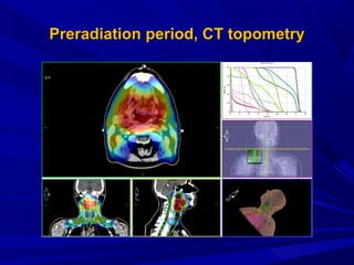 PreradiationPreradiation period, Сperiod, СT topometryT topometry
 