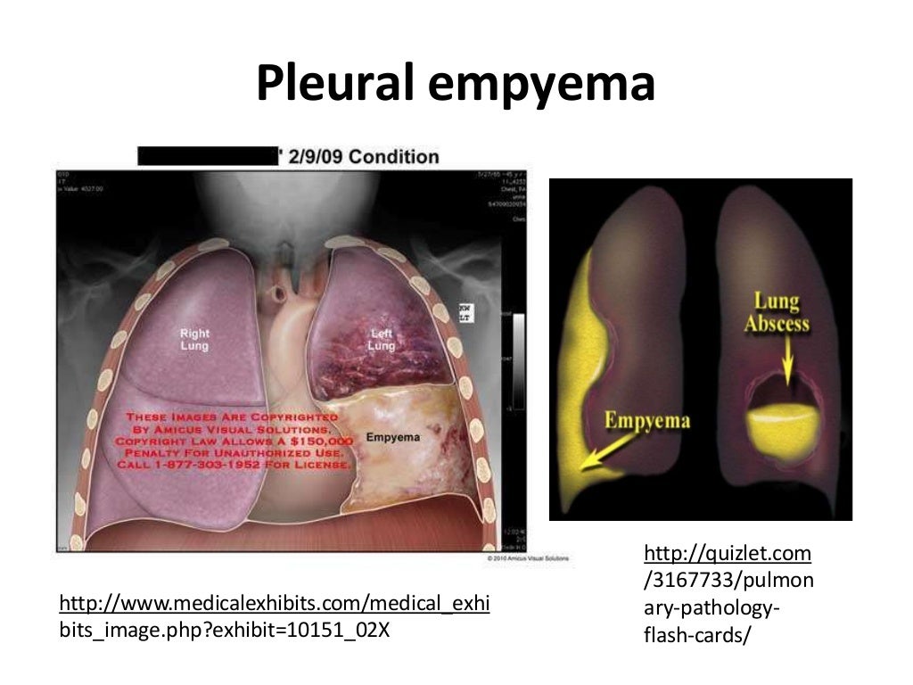 Pleural emphysema