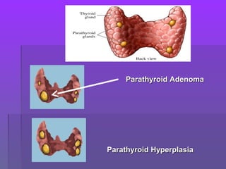 Parathyroid AdenomaParathyroid Adenoma
Parathyroid HyperplasiaParathyroid Hyperplasia
 