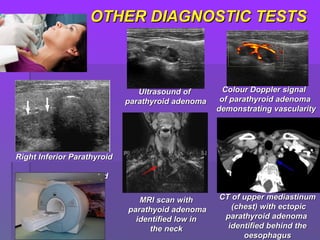 Right Inferior ParathyroidRight Inferior Parathyroid
Adenoma by UltrasoundAdenoma by Ultrasound
Ultrasound ofUltrasound of
parathyroid adenomaparathyroid adenoma
Colour Doppler signalColour Doppler signal
of parathyroid adenomaof parathyroid adenoma
demonstrating vascularitydemonstrating vascularity
CT of upper mediastinumCT of upper mediastinum
(chest) with ectopic(chest) with ectopic
parathyroid adenomaparathyroid adenoma
identified behind theidentified behind the
oesophagusoesophagus
MRI scan withMRI scan with
parathyoid adenomaparathyoid adenoma
identified low inidentified low in
the neckthe neck
OTHER DIAGNOSTIC TESTSOTHER DIAGNOSTIC TESTS
 