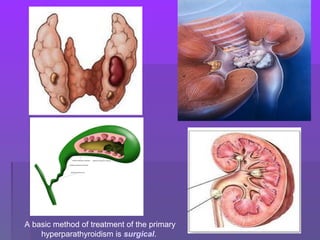 A basic method of treatment of the primary
hyperparathyroidism is surgical.
 