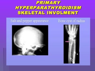 PRIMARYPRIMARY
HYPERPARATHYROIDISMHYPERPARATHYROIDISM
SKELETAL INVOLMENTSKELETAL INVOLMENT
 