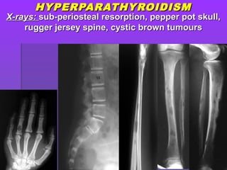 HYPERPARATHYROIDISMHYPERPARATHYROIDISM
X-rays:X-rays: sub-periosteal resorption, pepper pot skull,sub-periosteal resorption, pepper pot skull,
rugger jersey spine, cystic brown tumoursrugger jersey spine, cystic brown tumours
 