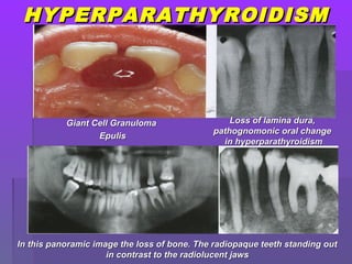 HYPERPARATHYROIDISMHYPERPARATHYROIDISM
Giant Cell GranulomaGiant Cell Granuloma
EpulisEpulis
Loss of lamina dura,Loss of lamina dura,
pathognomonic oral changepathognomonic oral change
in hyperparathyroidismin hyperparathyroidism
In this panoramic image the loss of bone. The radiopaque teeth standing outIn this panoramic image the loss of bone. The radiopaque teeth standing out
in contrast to the radiolucent jawsin contrast to the radiolucent jaws
 