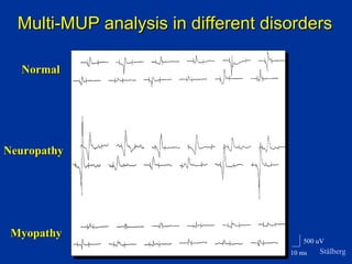 500 uV
10 ms
NormalNormal
NeuropathyNeuropathy
MyopathyMyopathy
Multi-MUP analysis in different disordersMulti-MUP analysis in different disorders
Stålberg
 