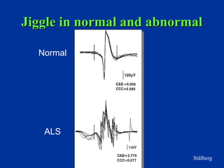 Jiggle in normal and abnormalJiggle in normal and abnormal
MUPsMUPs
Stålberg
Normal
ALS
 