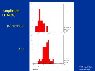 Amplitude
(Tib.ant.)
ZAMPTA
8
6
4
2
0
-2
-4
10
8
6
4
2
0
Std. Dev = 1,11
Mean = -1
N = 32,00
ZAMPTA
8
6
4
2
0
-2
-4
12
10
8
6
4
2
0
Std. Dev = 1,21
Mean = 1
N = 52,00
0.87
,13
polymyositis
ALS
Stålberg,Erdem
unpublished
SD
SD
-2SD +2SD
 