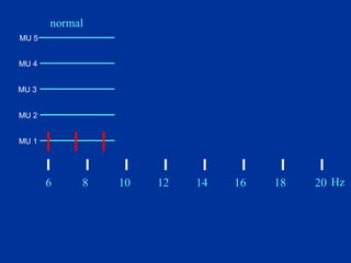 Onset freq = 6 Hz
Recruitment freq = 9Hz
Recruitment ratio 20/4=5
Interference
6 8 10 12 14 16 18 20 Hz
normal
MU 1
MU 2
MU 3
MU 4
MU 5
 
