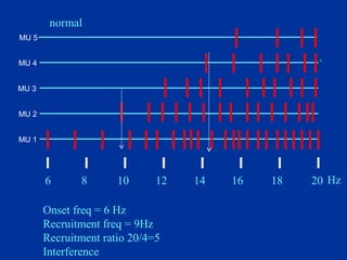 Onset freq = 6 Hz
Recruitment freq = 9Hz
Recruitment ratio 20/4=5
Interference
6 8 10 12 14 16 18 20 Hz
normal
MU 1
MU 2
MU 3
MU 4
MU 5
 