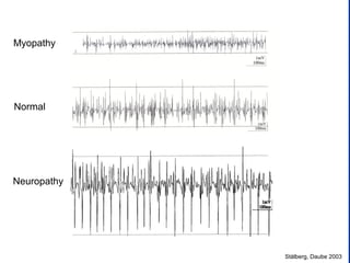 Stålberg, Daube 2003
Myopathy
Normal
Neuropathy
 