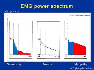 EMG power spectrumEMG power spectrum
Neuropathy Normal Myopathy
mBiceps brachii
A Fuglsang-Frederiksen
 