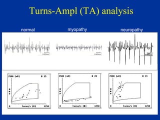 Turns-Ampl (TA) analysis
normal neuropathymyopathy
 