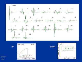 Myopathy
Tib ant
18446
IP MUP
Tib ant
 