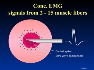 Conc. EMG
signals from 2 - 15 muscle fibers
Stålberg
Central spike
Slow wave components
 