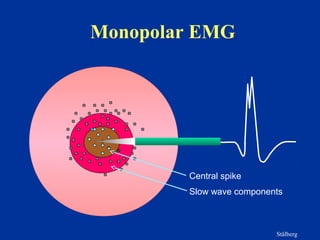Monopolar EMG
Stålberg
Central spike
Slow wave components
 