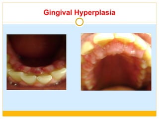 Gingival Hyperplasia
 