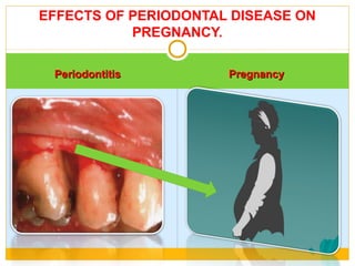 PeriodontitisPeriodontitis PregnancyPregnancy
EFFECTS OF PERIODONTAL DISEASE ON
PREGNANCY.
 