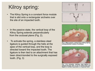 orthodontic management of impacted canine. | PPTX