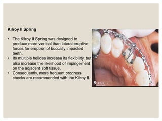 orthodontic management of impacted canine. | PPTX