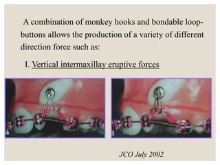 Bondable Loop orthodontic management of impacted canine. | PPTX