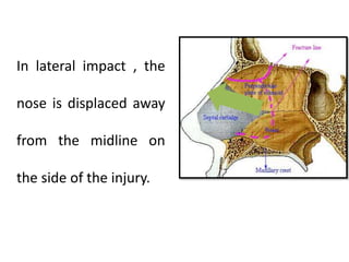 In lateral impact , the
nose is displaced away
from the midline on
the side of the injury.
 