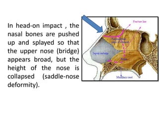 In head-on impact , the
nasal bones are pushed
up and splayed so that
the upper nose (bridge)
appears broad, but the
height of the nose is
collapsed (saddle-nose
deformity).
 