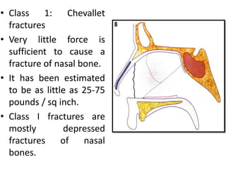 • Class 1: Chevallet
fractures
• Very little force is
sufficient to cause a
fracture of nasal bone.
• It has been estimated
to be as little as 25-75
pounds / sq inch.
• Class I fractures are
mostly depressed
fractures of nasal
bones.
 