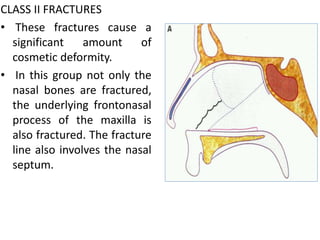 CLASS II FRACTURES
• These fractures cause a
significant amount of
cosmetic deformity.
• In this group not only the
nasal bones are fractured,
the underlying frontonasal
process of the maxilla is
also fractured. The fracture
line also involves the nasal
septum.
 