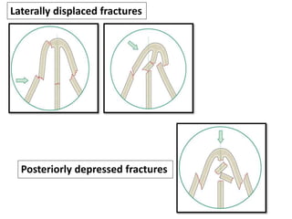 Laterally displaced fractures
Posteriorly depressed fractures
 