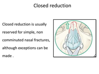 Closed reduction is usually
reserved for simple, non
comminuted nasal fractures,
although exceptions can be
made .
Closed reduction
 