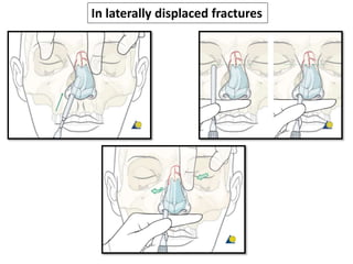 In laterally displaced fractures
 