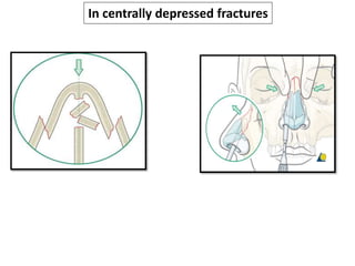In centrally depressed fractures
 