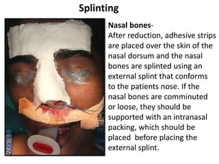 Nasal bones-
After reduction, adhesive strips
are placed over the skin of the
nasal dorsum and the nasal
bones are splinted using an
external splint that conforms
to the patients nose. If the
nasal bones are comminuted
or loose, they should be
supported with an intranasal
packing, which should be
placed before placing the
external splint.
Splinting
 
