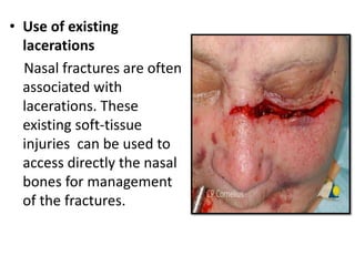 • Use of existing
lacerations
Nasal fractures are often
associated with
lacerations. These
existing soft-tissue
injuries can be used to
access directly the nasal
bones for management
of the fractures.
 