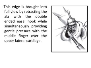 This edge is brought into
full view by retracting the
ala with the double
ended nasal hook while
simultaneously providing
gentle pressure with the
middle finger over the
upper lateral cartilage.
 