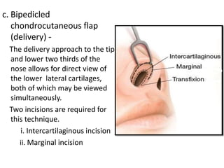 c. Bipedicled
chondrocutaneous flap
(delivery) -
The delivery approach to the tip
and lower two thirds of the
nose allows for direct view of
the lower lateral cartilages,
both of which may be viewed
simultaneously.
Two incisions are required for
this technique.
i. Intercartilaginous incision
ii. Marginal incision
 