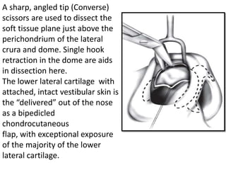 A sharp, angled tip (Converse)
scissors are used to dissect the
soft tissue plane just above the
perichondrium of the lateral
crura and dome. Single hook
retraction in the dome are aids
in dissection here.
The lower lateral cartilage with
attached, intact vestibular skin is
the “delivered” out of the nose
as a bipedicled
chondrocutaneous
flap, with exceptional exposure
of the majority of the lower
lateral cartilage.
 
