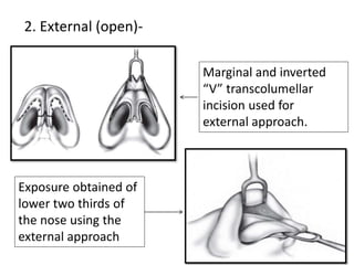 2. External (open)-
Marginal and inverted
“V” transcolumellar
incision used for
external approach.
Exposure obtained of
lower two thirds of
the nose using the
external approach
 