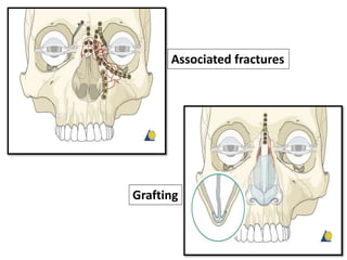 Associated fractures
Grafting
 