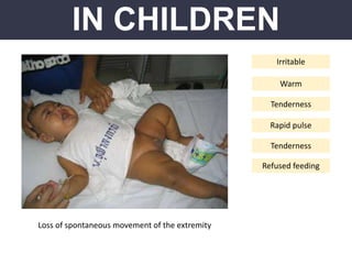 IN CHILDREN
Loss of spontaneous movement of the extremity
Irritable
Warm
Tenderness
Rapid pulse
Tenderness
Refused feeding
 