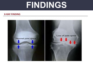 FINDINGS
X-RAY FINDING
 