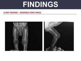 FINDINGS
X-RAY FINDING – WIDENED JOINT SPACE
 