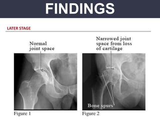 FINDINGS
LATER STAGE
 